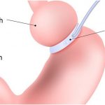 surgeon do in lap band surgery