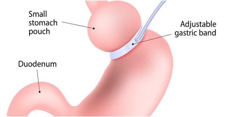 surgeon do in lap band surgery