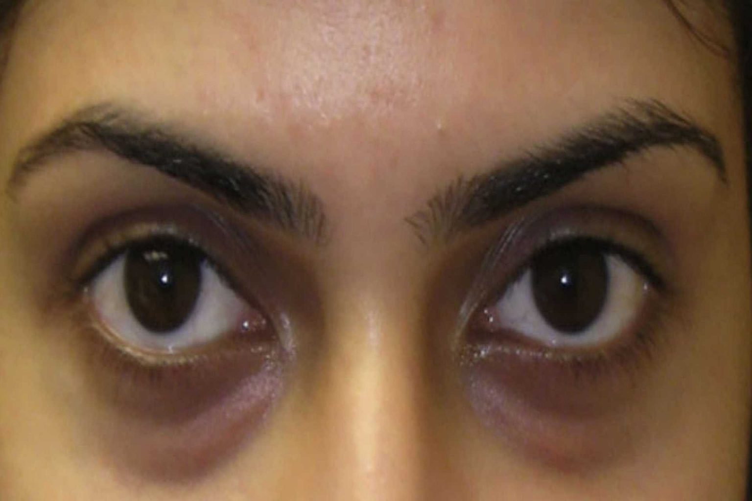 Under Eye Dark Circles Reasons and Solutions EQ Fitness