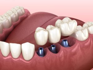 Are Dental Implants Real Teeth