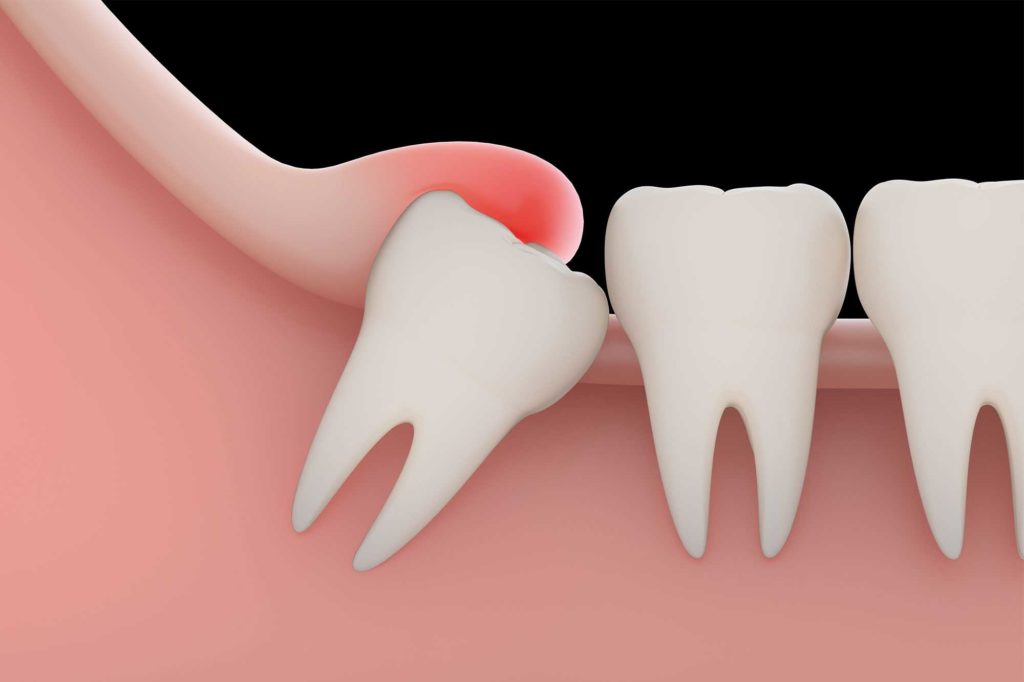 Wisdom Teeth Extraction: Your Road to Relief